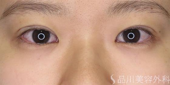 症例NO.48053のAFTER写真