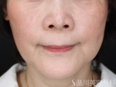 症例NO.71457のAFTER写真