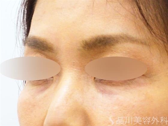 症例NO.51420のBEFORE写真