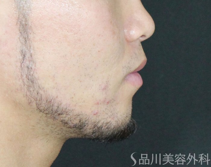 症例NO.70238のBEFORE写真