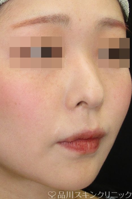 症例NO.74077のBEFORE写真