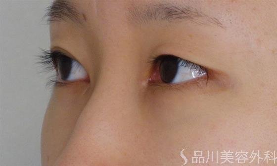 症例NO.52942のBEFORE写真