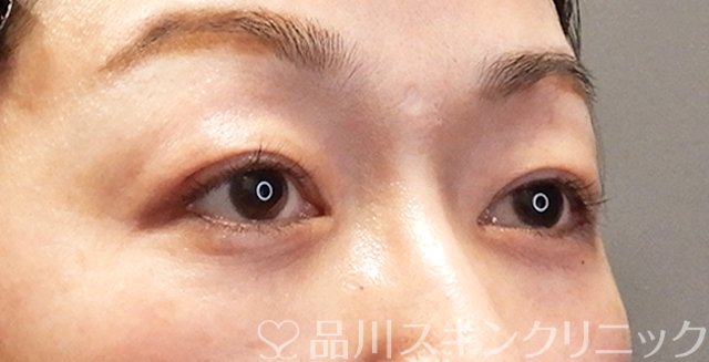 症例NO.68898のAFTER写真