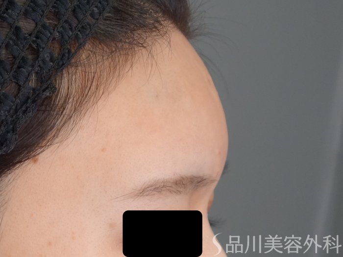 症例NO.69225のAFTER写真