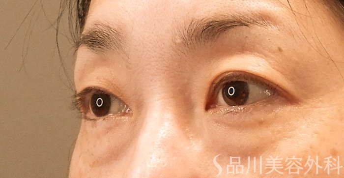 症例NO.70565のBEFORE写真