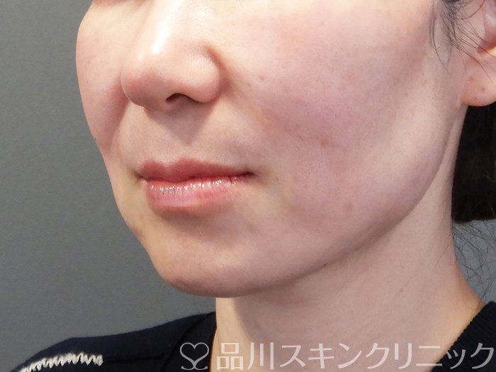 症例NO.74103のAFTER写真