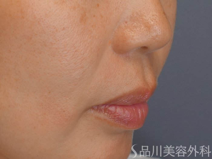 症例NO.71828のAFTER写真