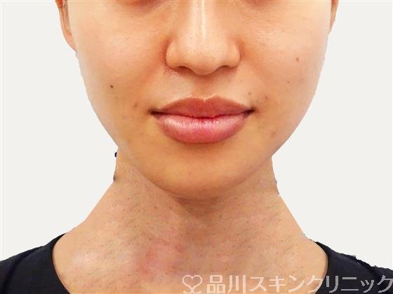 症例NO.48261のAFTER写真