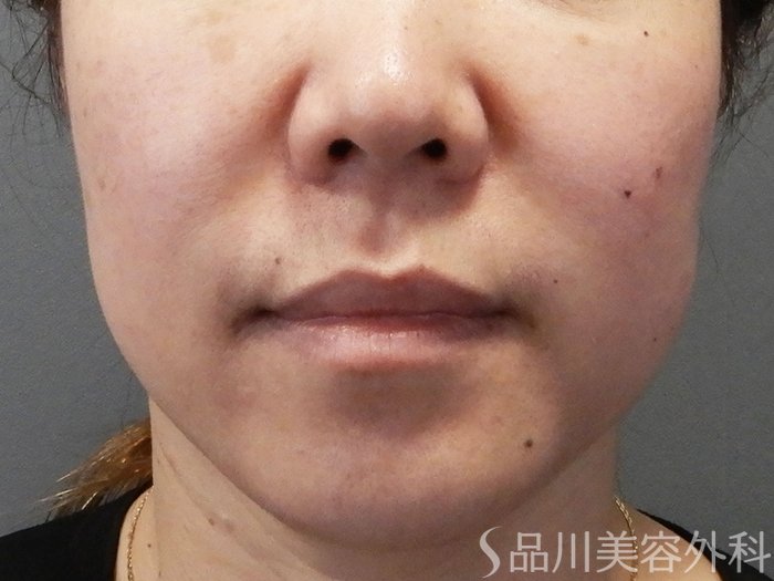 症例NO.70960のBEFORE写真
