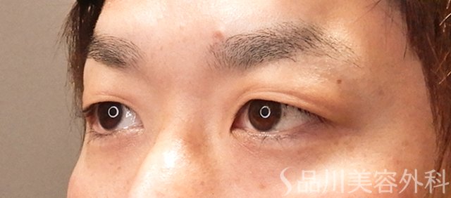 症例NO.70985のBEFORE写真
