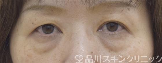 症例NO.52830のBEFORE写真