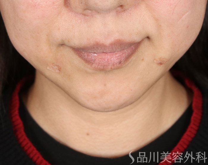 症例NO.72245のAFTER写真