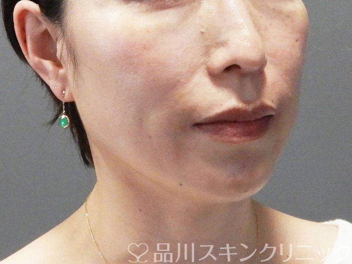 症例NO.74357のAFTER写真