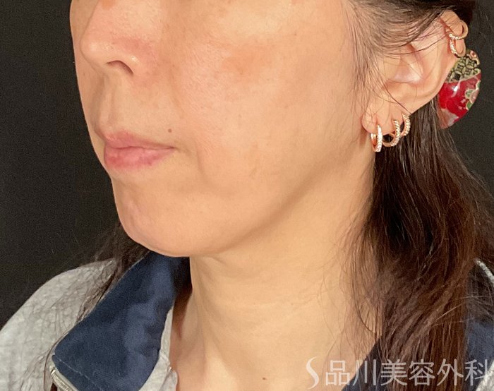 症例NO.75016のBEFORE写真
