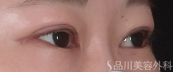 症例NO.69201のAFTER写真