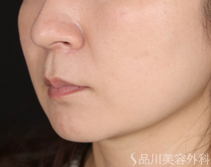 症例NO.72389のBEFORE写真