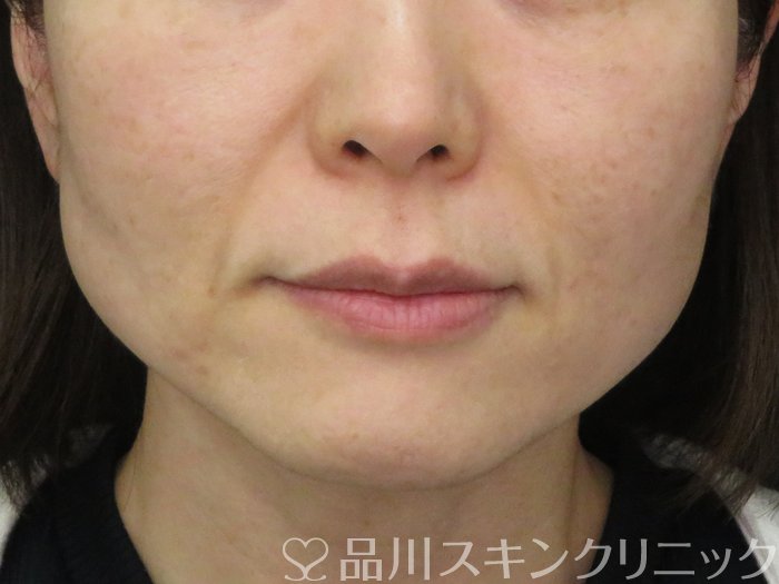 症例NO.70603のBEFORE写真