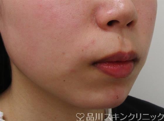 症例NO.40021のAFTER写真
