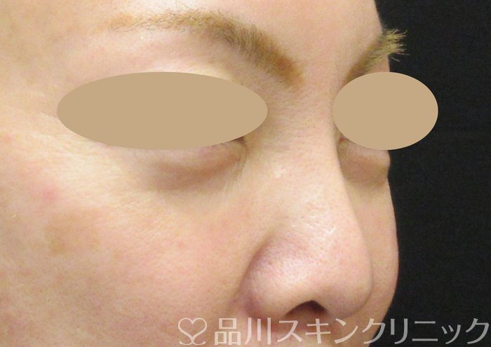 症例NO.73966のAFTER写真