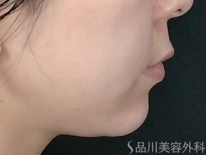 症例NO.70616のAFTER写真