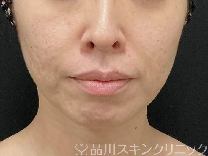 症例NO.74915のBEFORE写真