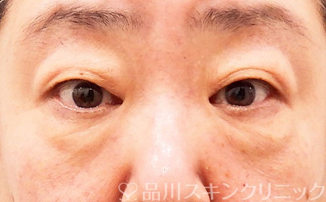 症例NO.62239のBEFORE写真