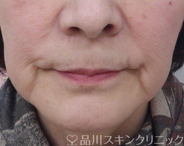 症例NO.69343のBEFORE写真