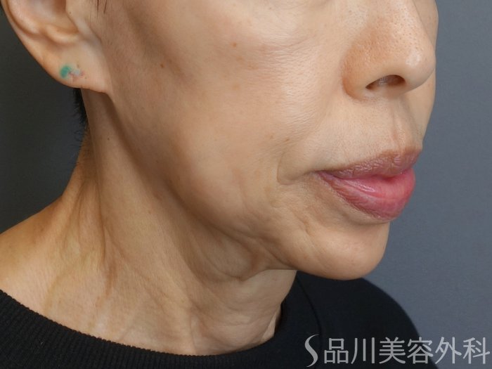 症例NO.72641のBEFORE写真