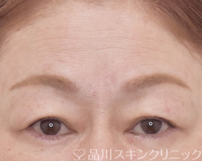 症例NO.65420のBEFORE写真