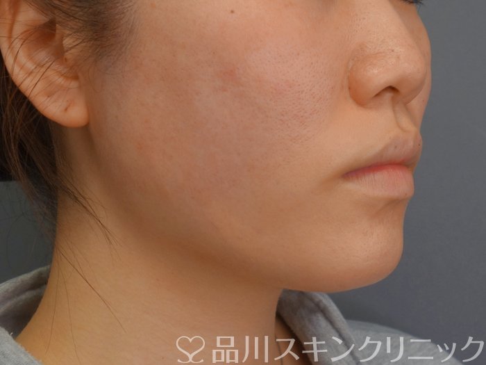 症例NO.74136のAFTER写真