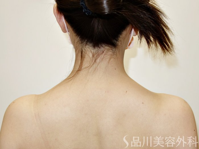 症例NO.73179のBEFORE写真