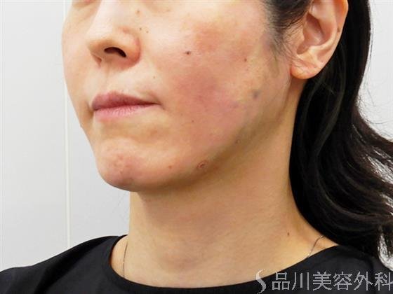 症例NO.51930のAFTER写真