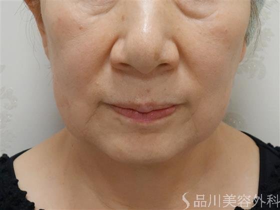 症例NO.37118のBEFORE写真