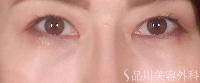 症例NO.70613のAFTER写真