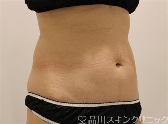 症例NO.47579のAFTER写真