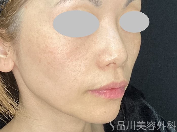 症例NO.72541のBEFORE写真