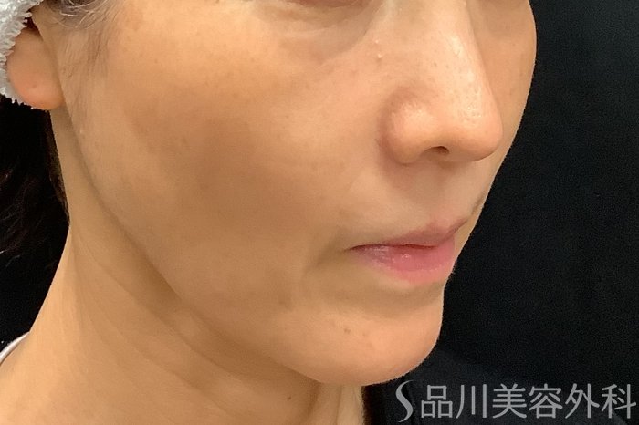 症例NO.71248のBEFORE写真