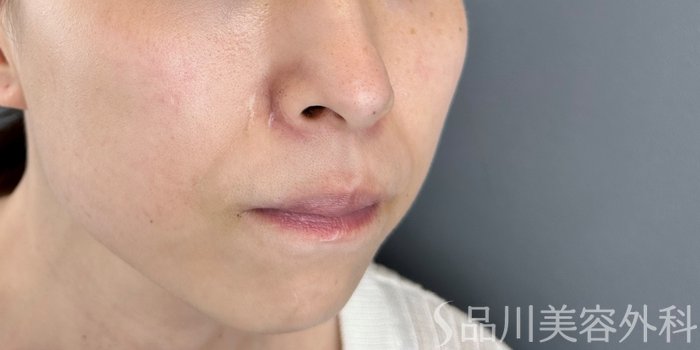 症例NO.71077のAFTER写真