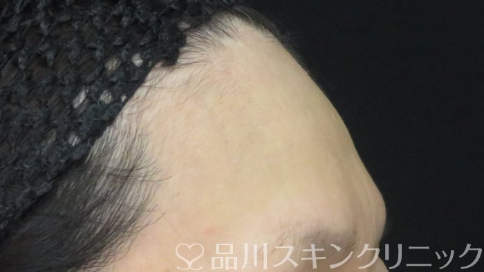 症例NO.71901のBEFORE写真