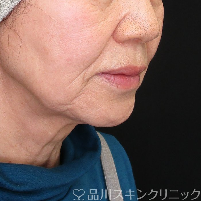 症例NO.73673のBEFORE写真