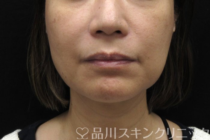 症例NO.74422のBEFORE写真