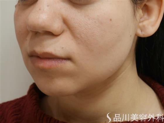 症例NO.41751のBEFORE写真