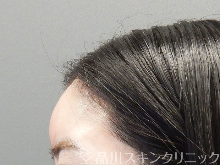 症例NO.72790のAFTER写真