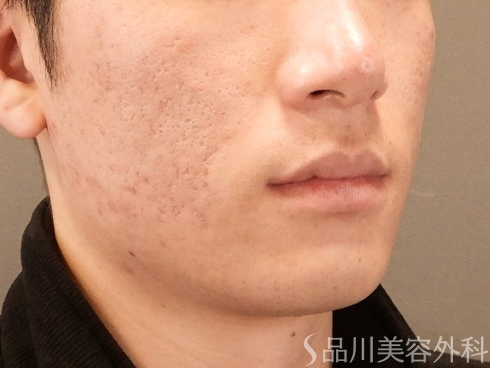 症例NO.71016のAFTER写真