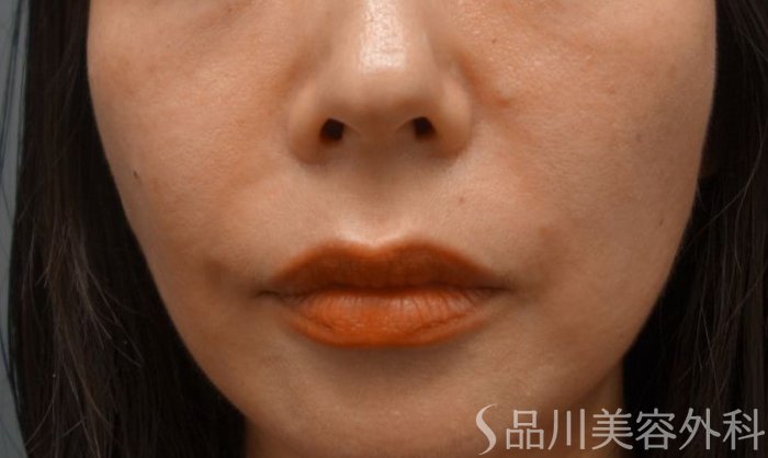 症例NO.65070のAFTER写真