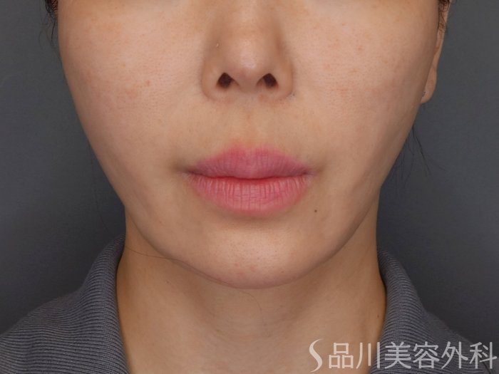 症例NO.72145のBEFORE写真