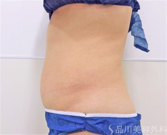 症例NO.17925のAFTER写真