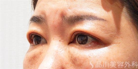 症例NO.53706のAFTER写真