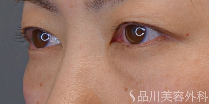 症例NO.72943のBEFORE写真