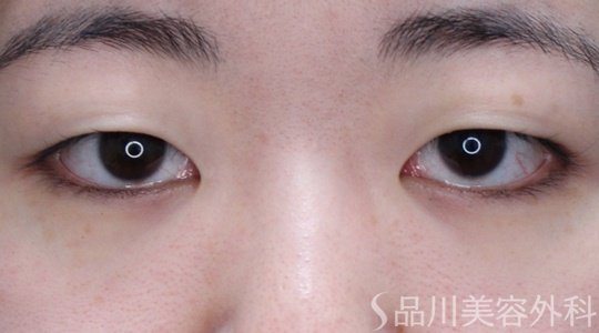 症例NO.69676のBEFORE写真